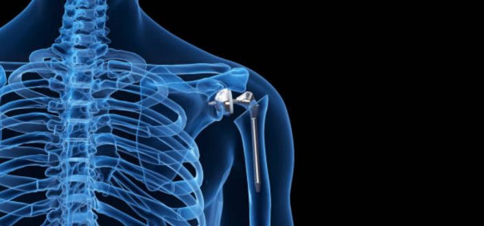 Dr. Álvaro Velarde and Dr. Carlos Galindo, publish a scientific research in the Journal of Orthopaedic Surgery and Research